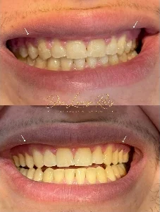 Antes e depois de tratamento no sorriso
